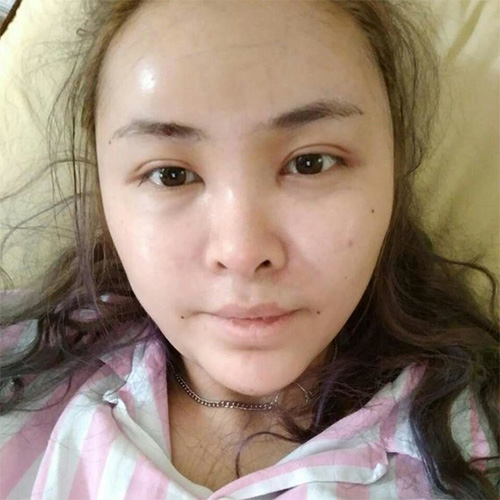 脂肪填充五年后可能出現(xiàn)的后遺癥，脂肪填充五年后可能出現(xiàn)的后遺癥及預(yù)防措施