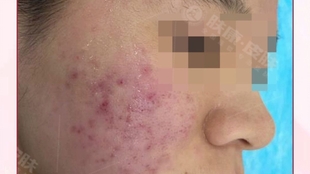 治療痤瘡的費(fèi)用分析，了解花費(fèi)多少以及背后的因素，治療痤瘡的費(fèi)用詳解，了解花費(fèi)背后的因素