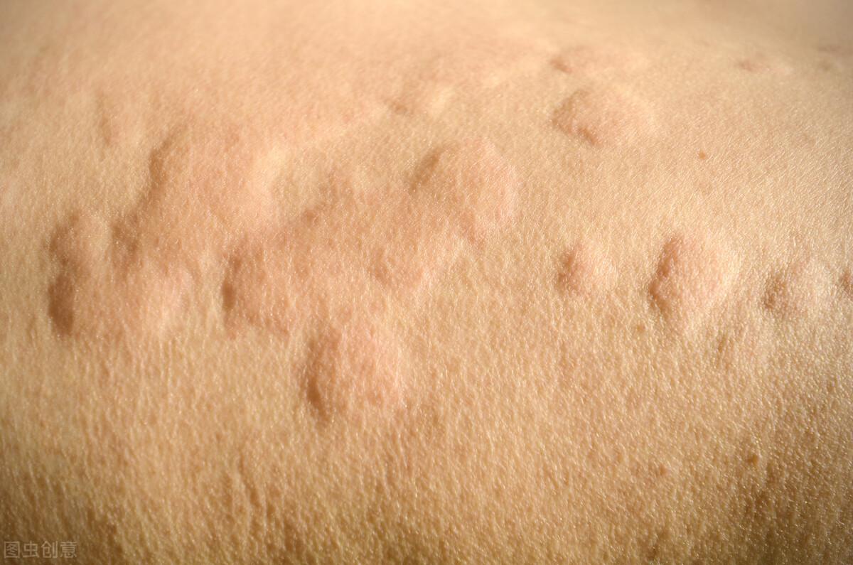 熱性蕁麻疹，成因、癥狀與應對策略，熱性蕁麻疹，成因、癥狀及應對之策