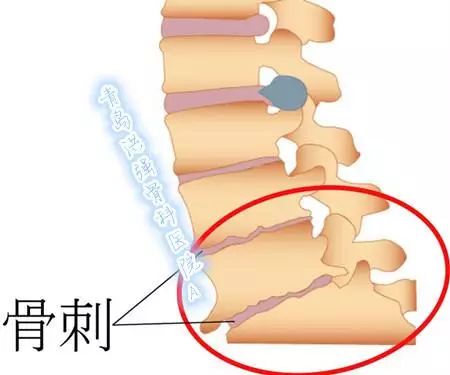骨刺的最佳治療方法，骨刺的最佳治療方法解析