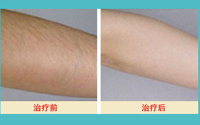 激光脫毛的價(jià)格解析，多少錢才能擁有絲滑肌膚？，激光脫毛價(jià)格詳解，多少錢能擁有絲滑肌膚？