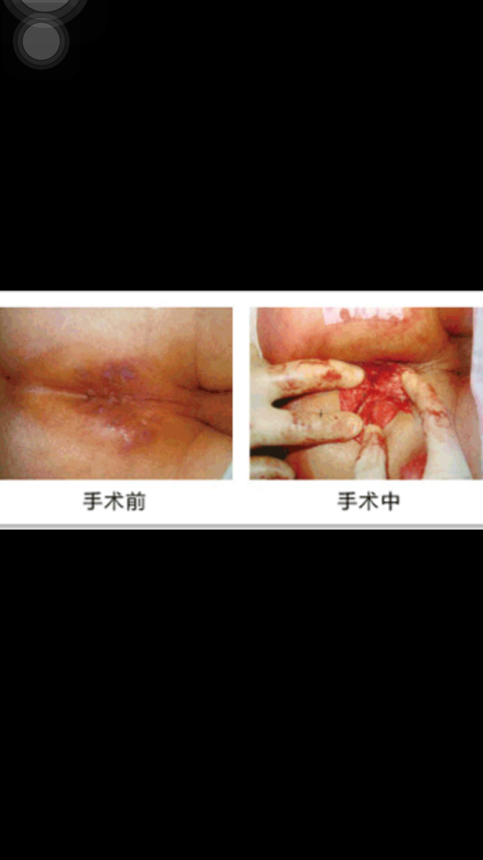 肛瘺圖片，了解癥狀、診斷與治療，肛瘺詳解，癥狀、診斷、治療及圖片參考