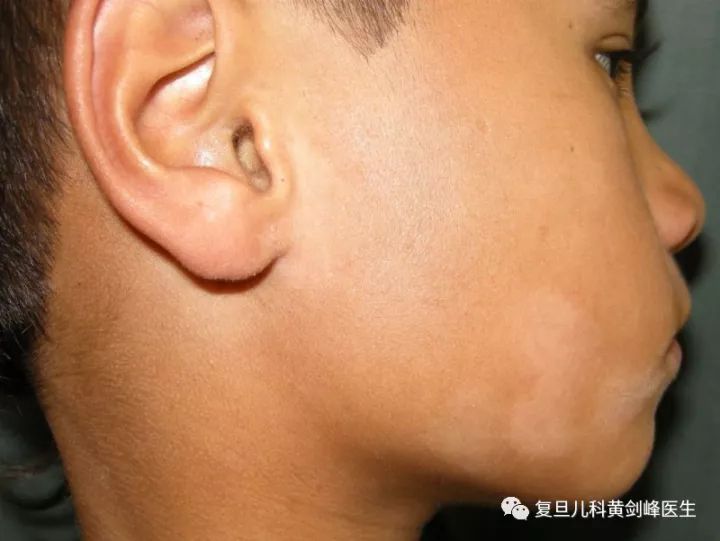 白色糠疹，了解、預(yù)防與治療，白色糠疹，全面解析、預(yù)防與治療方法