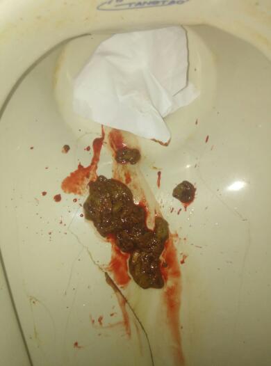 上大號(hào)拉出血怎么回事——解析便血的可能原因與應(yīng)對(duì)措施，解析，大便出血的原因及應(yīng)對(duì)措施