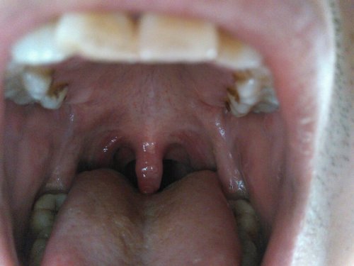 嗓子感覺糊了一層粘液，原因、緩解與預(yù)防策略，嗓子糊粘液，成因、緩解及預(yù)防策略