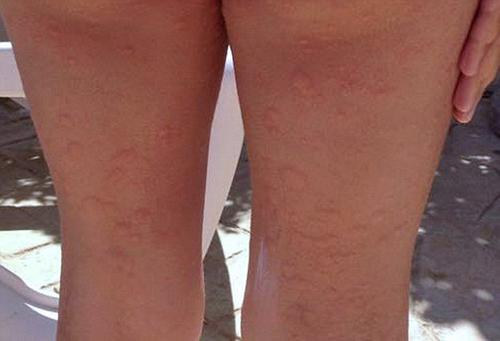 蕁麻疹的治療方法，全方位解析與應對策略，全方位解析蕁麻疹治療方法與應對策略