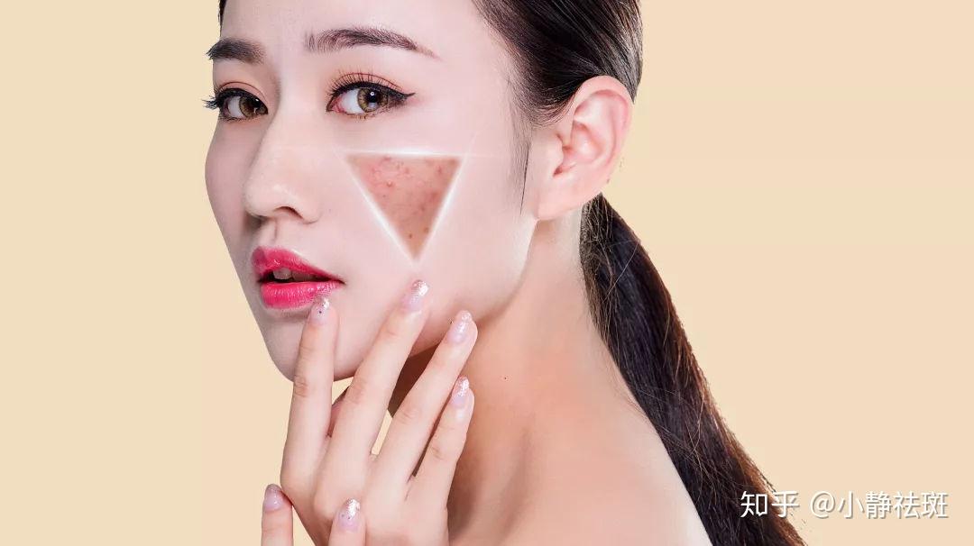 如何有效去除臉上的雀斑，最佳方法全解析，全面解析，如何有效去除臉上雀斑的方法