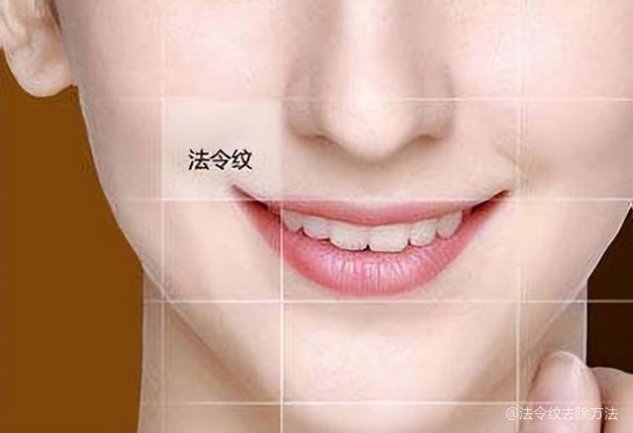 如何去除法令紋——打造青春無痕肌膚，如何消除法令紋，重塑青春無瑕肌膚