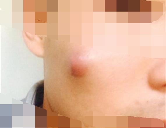 臉上一摸全是小顆粒，原因解析與應對方法，臉部小顆粒密布，原因解析及應對方法