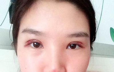 割雙眼皮的危害和后遺癥，割雙眼皮的危害和后遺癥概覽