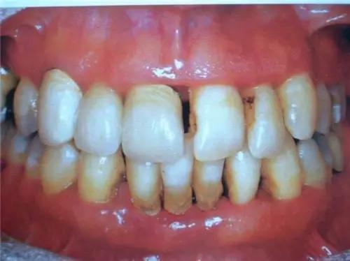 牙齦萎縮初期圖片及其相關(guān)知識解析，牙齦萎縮初期圖片與相關(guān)知識詳解