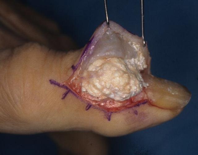 痛風(fēng)結(jié)晶溶解時間，影響因素與應(yīng)對策略，痛風(fēng)結(jié)晶溶解的時間、影響因素及應(yīng)對策略詳解